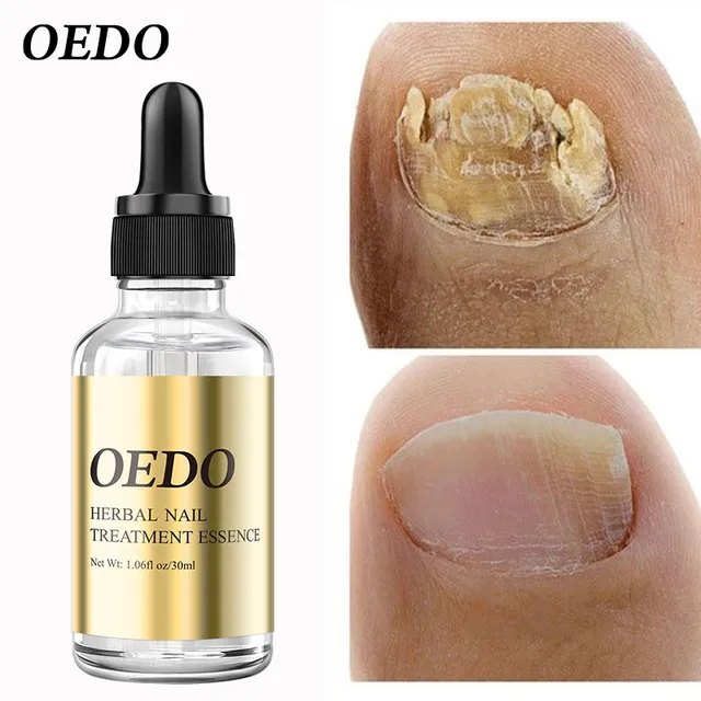 Fungal Nail Treatment Essential Oi