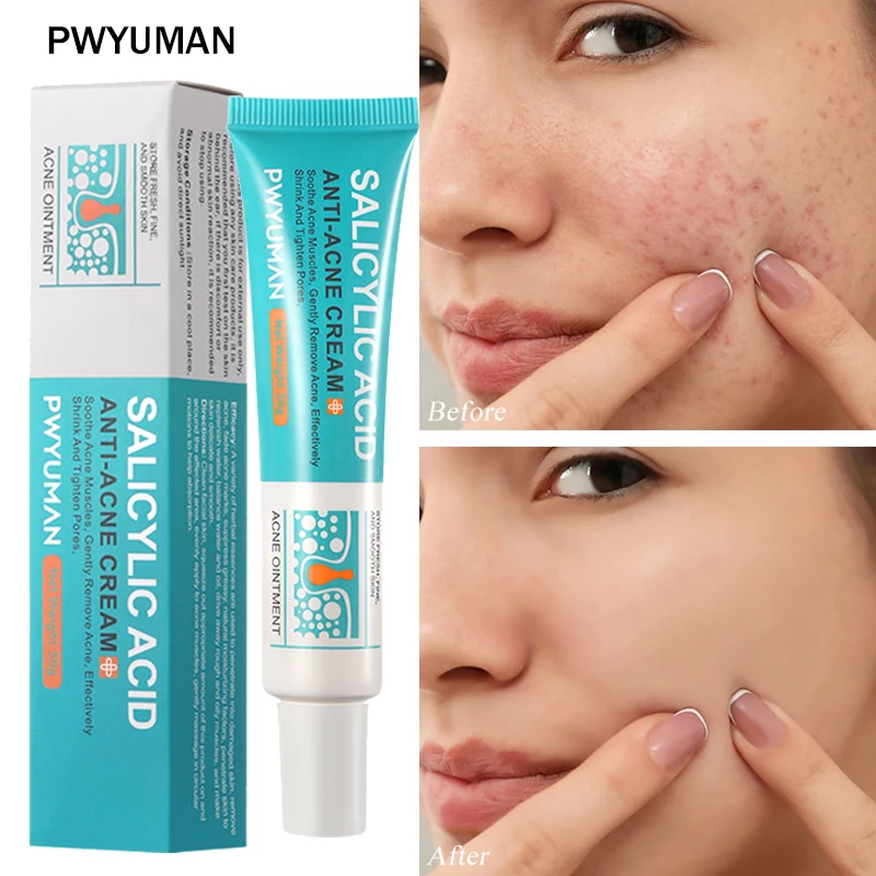 

Salicylic Acid Acne Removal Cream Face Treatment Moisturizing Oil Control Shrink Pore Repair Fade Redness Pimple Scar Skin Care