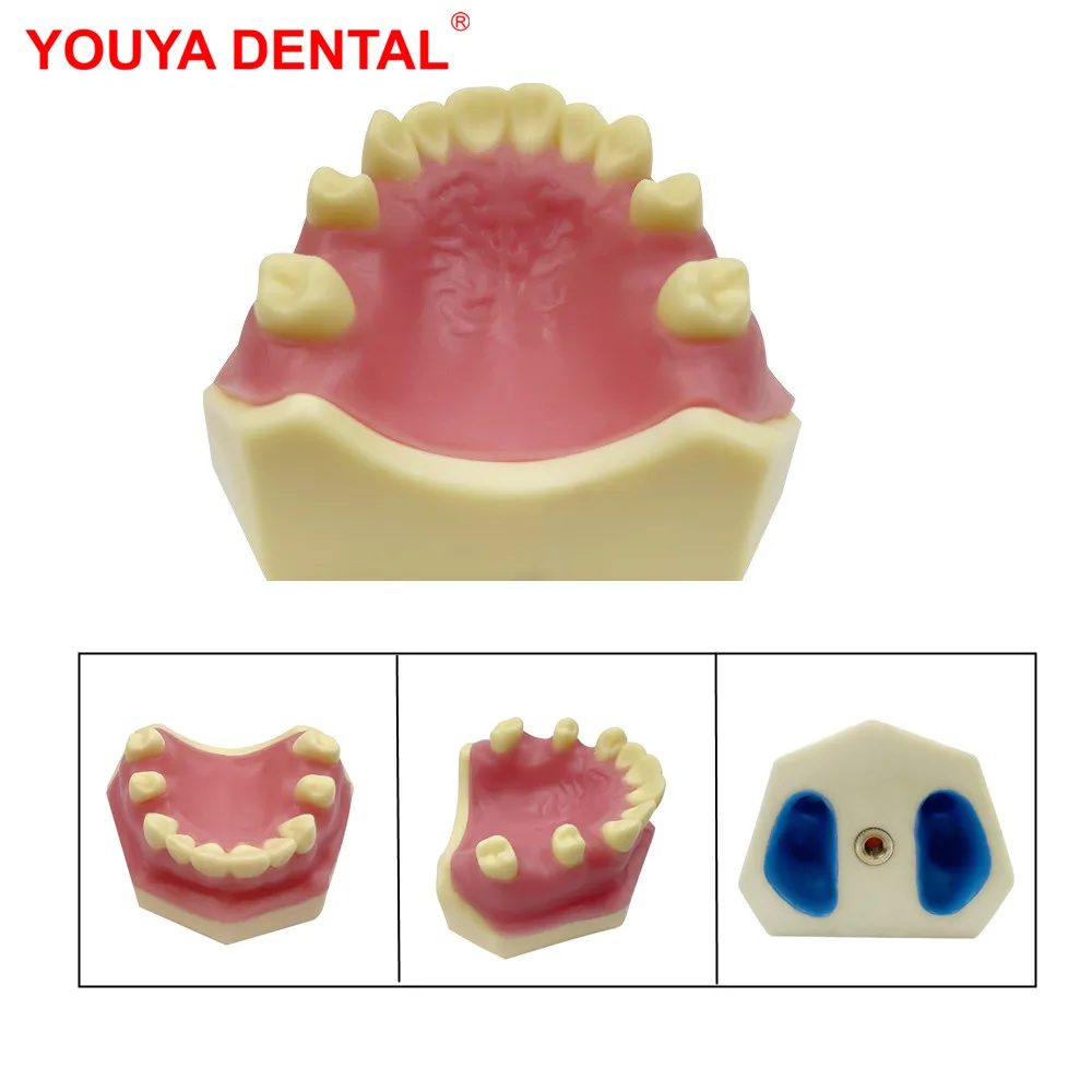 

1pc Dental Model Teeth Implant Practice Model For Dental Students Dentist Studying Training Examation Dentistry Teaching Product