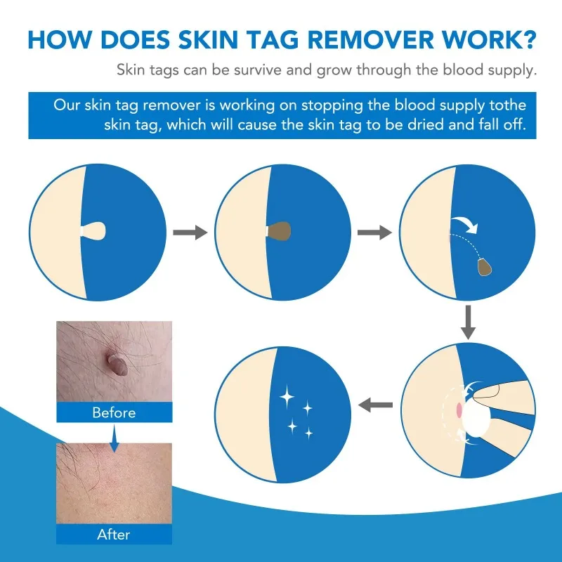 Skin Tag Wart Removal Kit Remover Equipment Micro Skin Tag Removeal Tool Easy To Clean Care