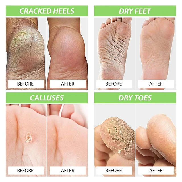 Joypretty Exfoliator Foot Cream Dead Skin Remover Heel Treatment Crack Care Foot  Feet Hand Repair Mask Cream Skin Moisturiz Q9W8 - AliExpress