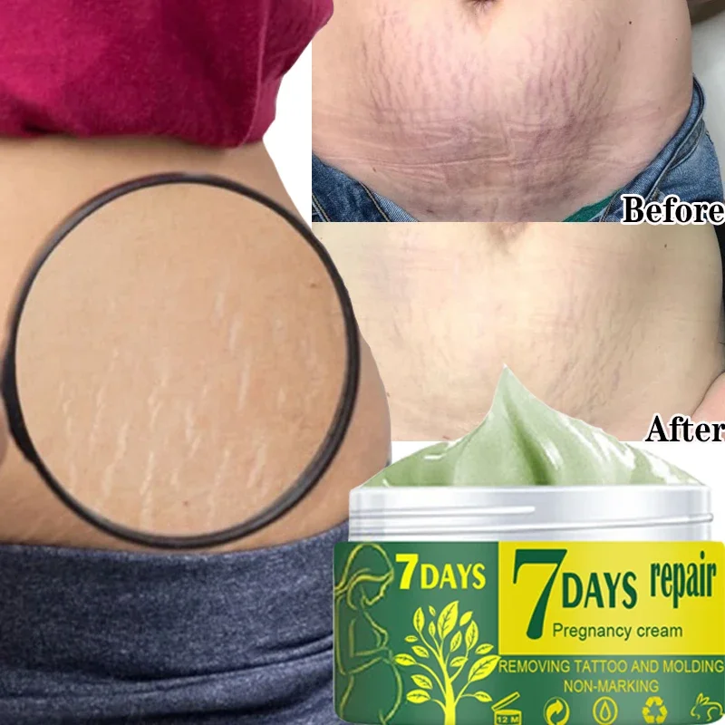 

Effective Remove Pregnancy Scars Acne Cream Stretch Marks Treatment Maternity Repair Anti-Aging Anti-Winkles Firming Body Creams