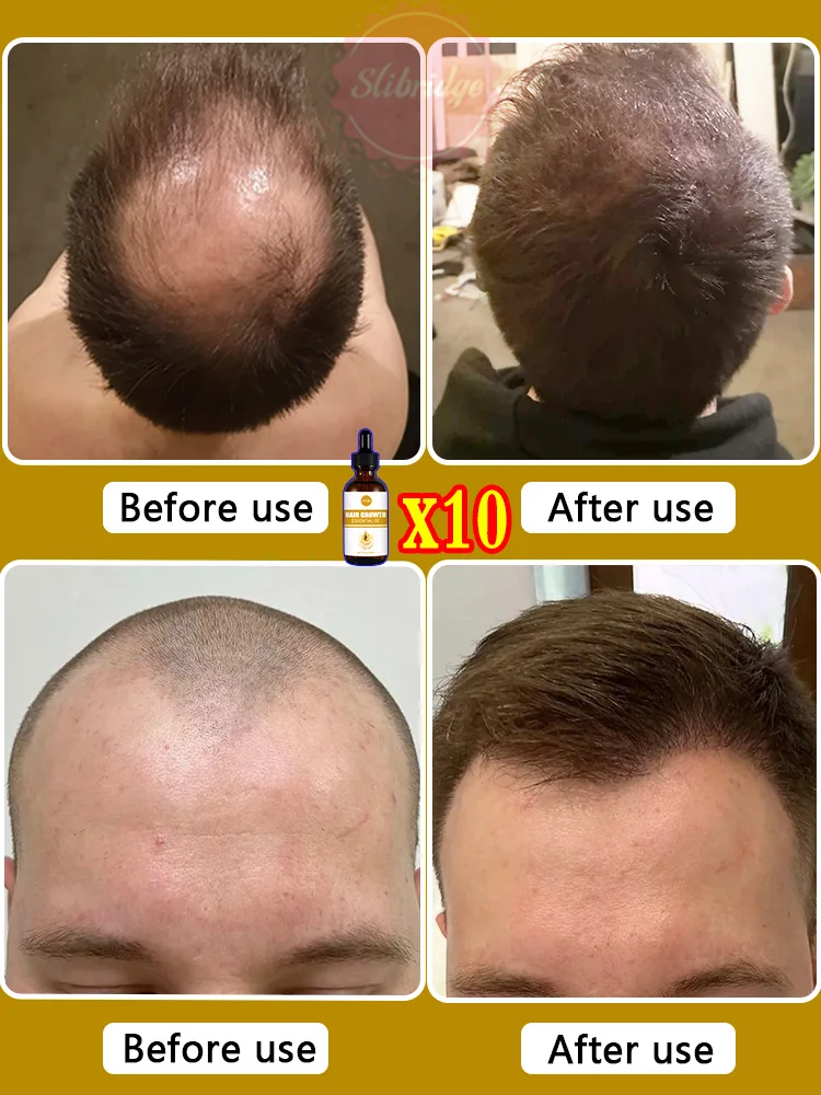 Hair growth essential oil. Effectively repair baldness and hair loss symptoms