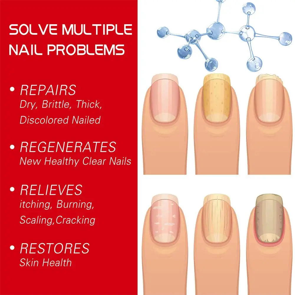 Nail Fungus Remover 20ml Nail Fungal Treatment Essence Oil Serum Repair Anti Infection Gel