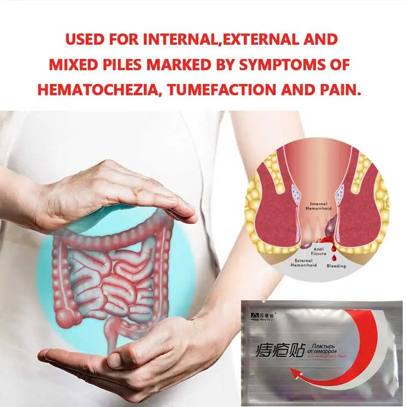 External Piles In Women