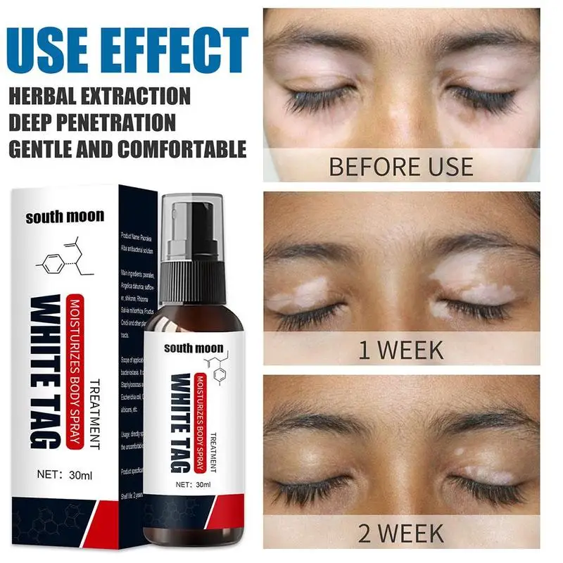 Vitiligo treatment cream Vitiligo relief spray Skin treatment lamp White Spot Removal vitiligo ointment Eliminate vitiligo ointment