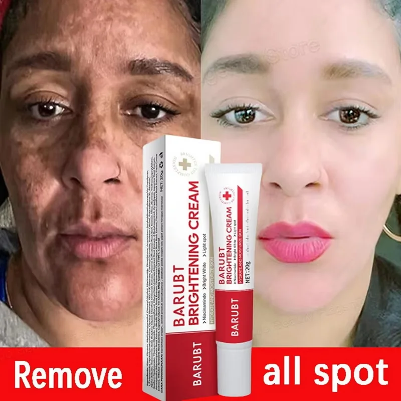 Facial Cream Whitening Freckles Removal Melasma Dark Spots Corrector Lighten Melanin Pigmentation Brighten Anti-Aging
