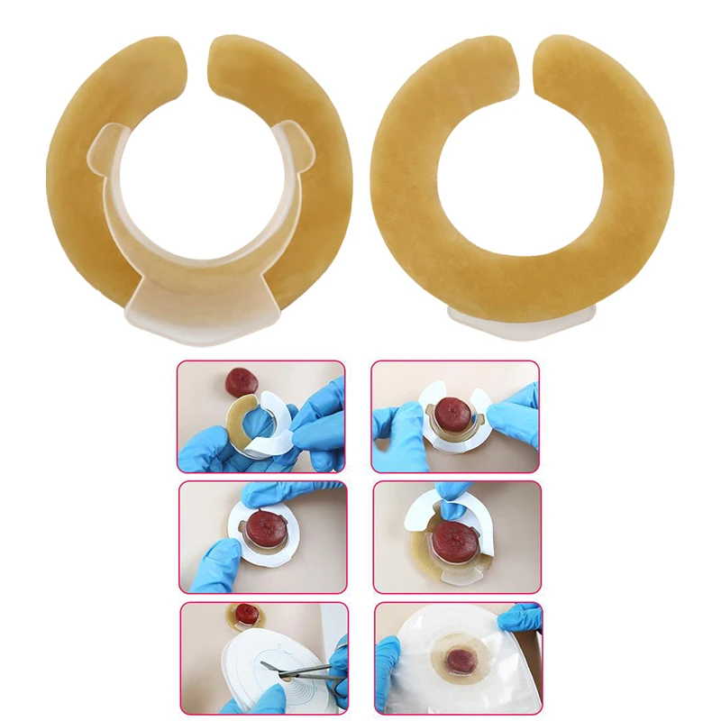 Anti-Leakage Ring For Colostomy Bag Ostomy Paste Ring Base Plates Stoma Care Products To Protect Skin