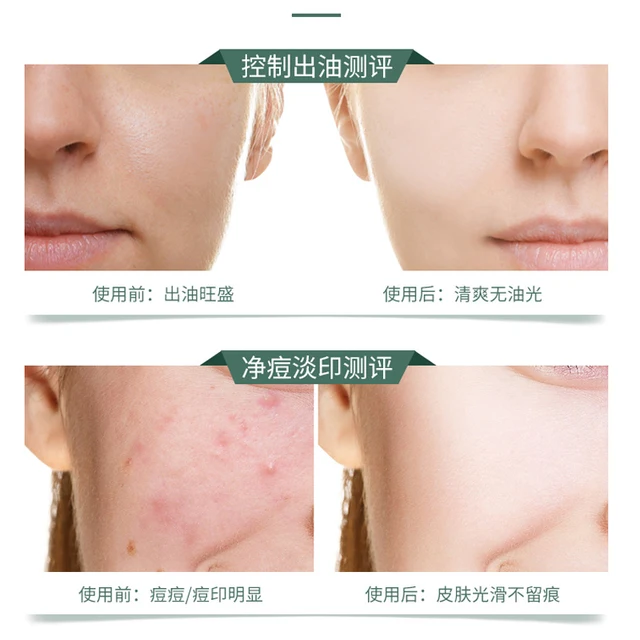 A verdadeira essência da beleza em uma loção refrescante para peles propensas à acne.