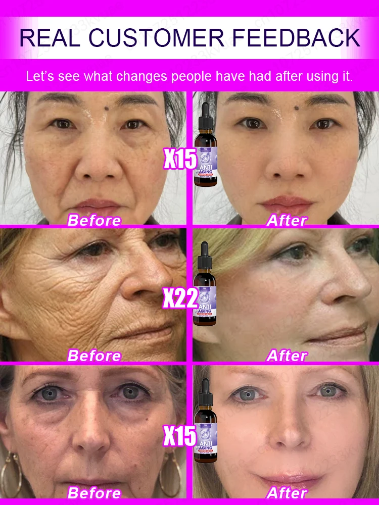 20 years younger，Wrinkles disappear 2