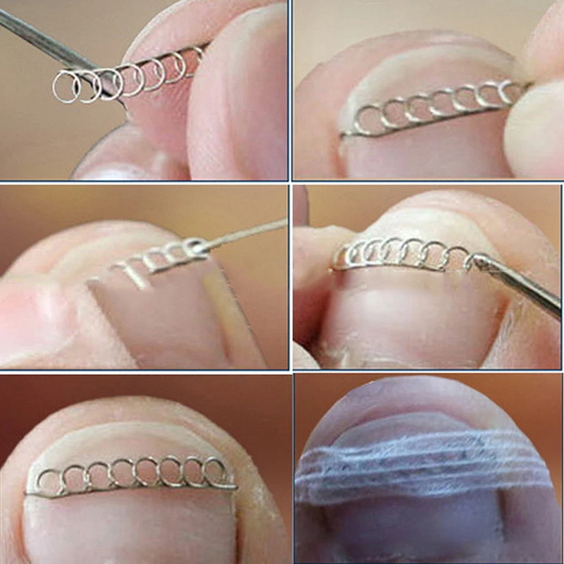 alt="The 12PCs Ingrown Toe Nail Correction Wire Fixer, a Foot Care Tool for recovery.