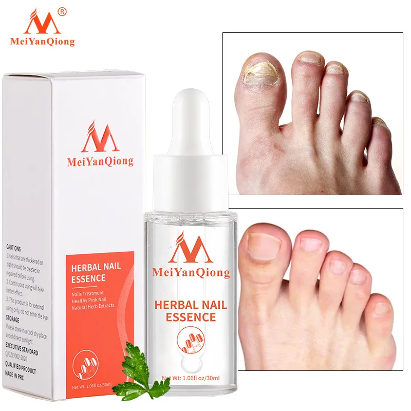 

Herbal Nail Treatment Serum Nail Fungus Anti Infection Paronychia Onychomycosis Restore Essence Nail Repair Oil Hand Foot Care