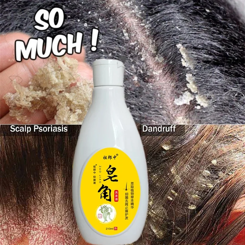 

Saponin Therapeutic Shampoo Anti-Dandruff Treatment Itching and Flaking Scalp Psoriasis Seborrheic Dermatitis 210ml7.1fl oz)
