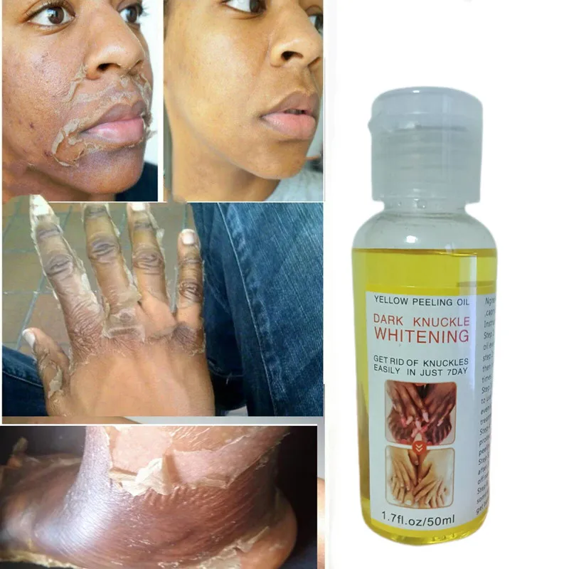 

Желтое пилинг, масло для отбеливания, темные пятна кожи, черные точки, пятна, лечение плохих точек кожи, дополнительное масло для пилинга