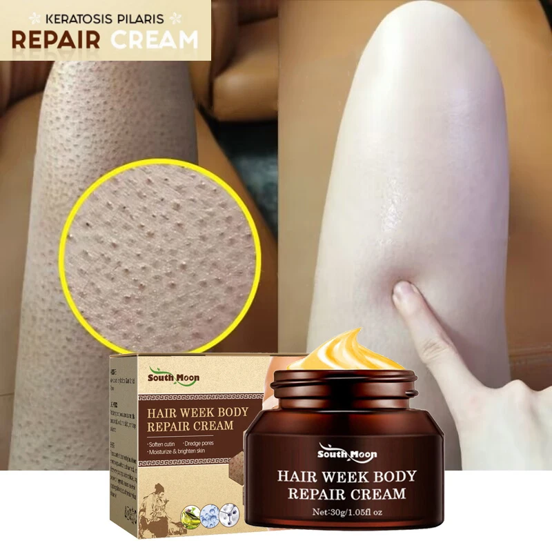 Keratosis Pilaris Repair Treatment Cream Clearing Acne Spots Removal Chicken Skin Goose Bumps Deep Moisturizing Smooth Skin Care