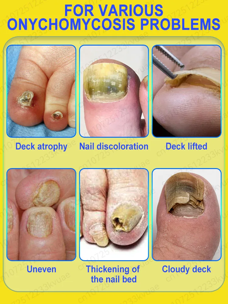 Fungus Solution Organic Essential Oil Toenail Nail Fungus Treatment Repair Fingerail Device Toenail Treatment for Foot Nail Fungus Essential Oil Onychomycosis Care