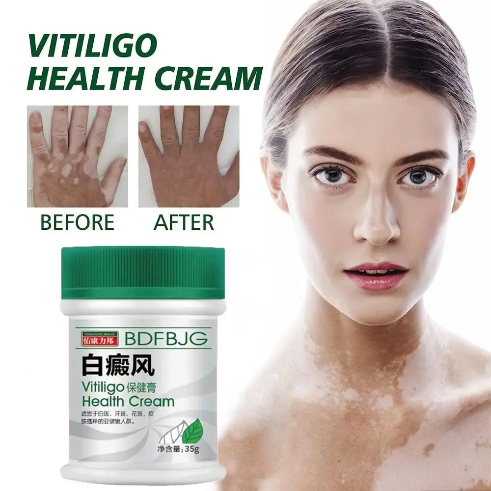 Natural TreatVitiligo Soothing Cream Skin Care Improve Skin Discoloration Vitiligo Care Cream Fast Penetration Fast Soothing