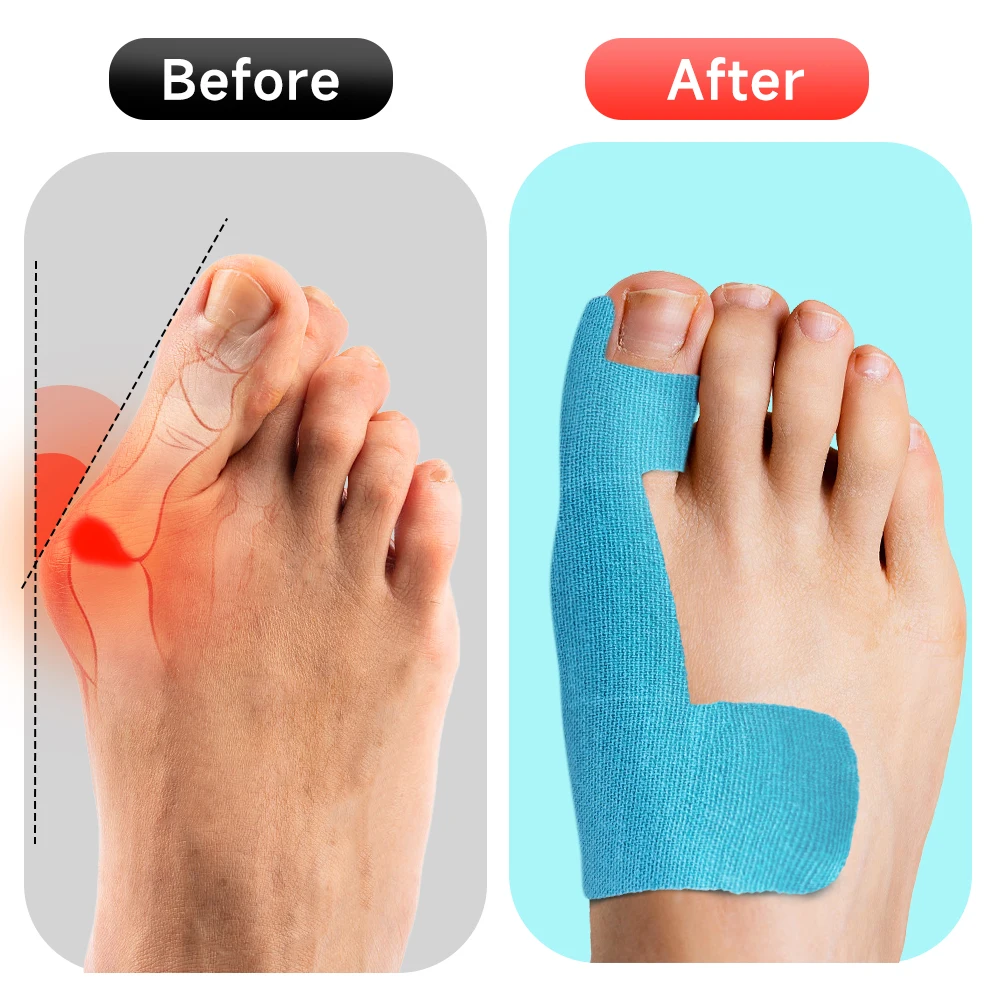 Bunion Corrector Tape Hallux Valgus Orthosis for Big Toe Pain Relief Correction Toe Separator Sports Protective Straightener