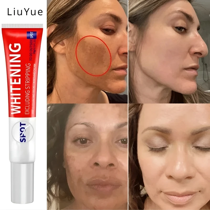 Whitening Freckle Cream Quickly Removes Melasma Dark Spots Lightens Melanin Anti-pigmentation Improves Darkness Brightens Cream