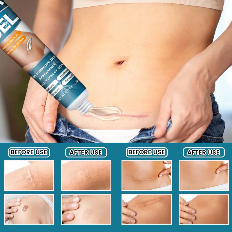 Liquid Bandage Spray ERAYCEE Thin Scar Gel Thin Scar Scald Abdominal Skin Care
