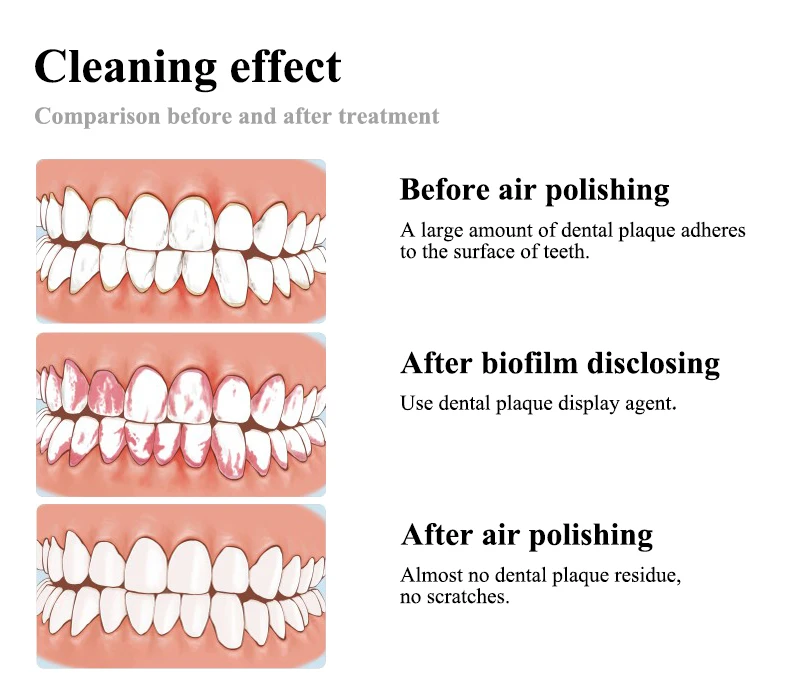 VV Dental Air Polisher Zahnweiß-Spray Dental-Bikarbonat-Jet Air Flowair für Mundhygiene-Reinigung Dentalwerkzeuge – Detail 5