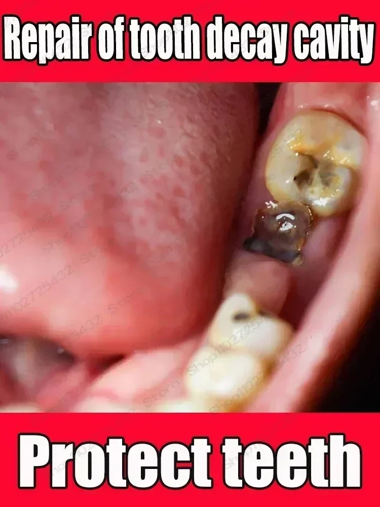 Teeth Health Product Anti Decay Toothpaste Dental Caries Repair Cream Prevent Tooth Decay Protect Teeth 30g