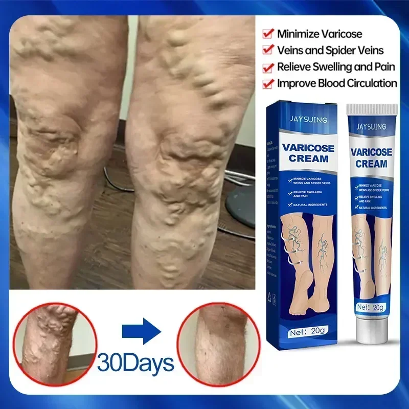 Ointment for Varicose Veins Relieve Spider Leg Pain