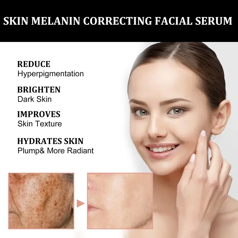 Whitening Freckle Serum Fade Melasma Dark Spots Remove Pigment Brighten Lighten Melanin Improve Dull Anti-aging Face Skin Care