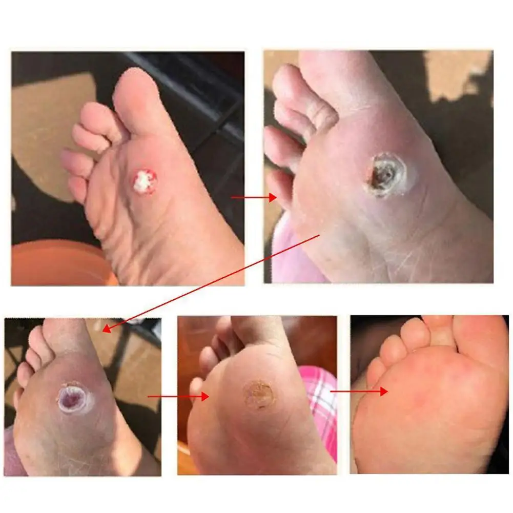 Toe And Foot Protectors Pads Corns Callus Feet Sore Shoes Sticker Self Adhesive Cushions Soft Heel Pad Foam Foot Paste 30PCS heel pad toe protector foot pad