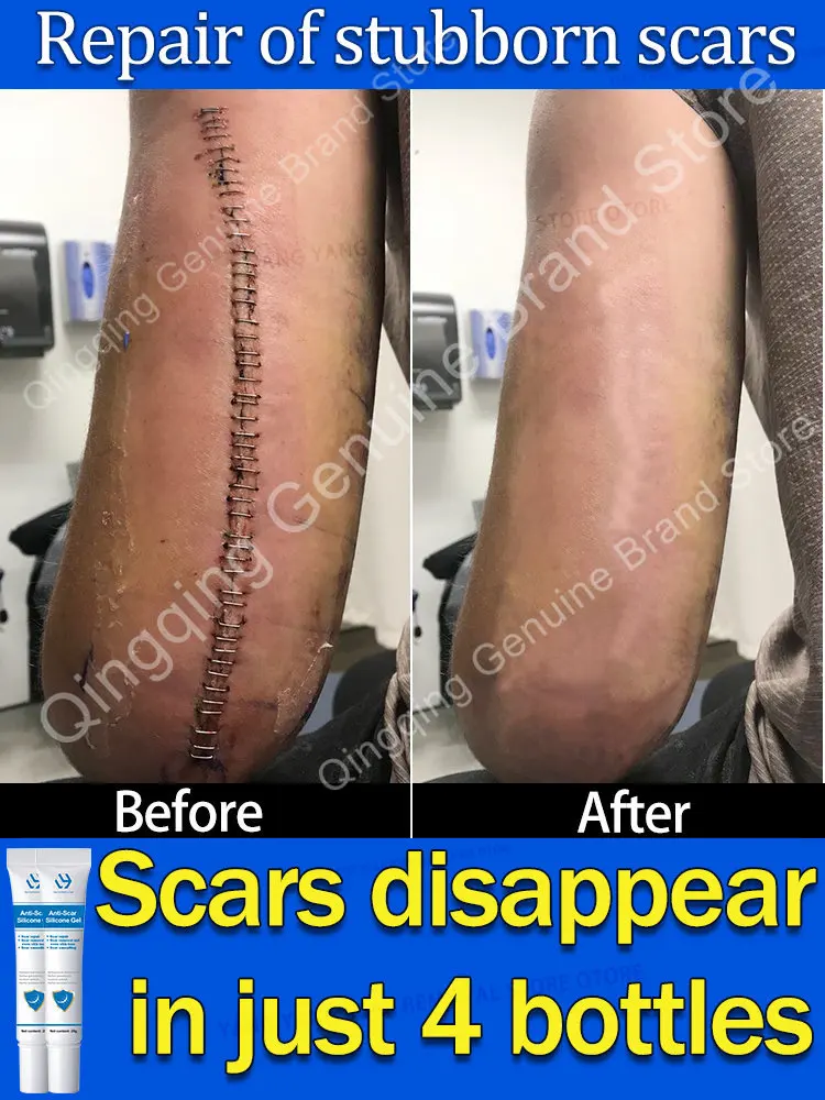 

scar removal cream hyperplastic scars scar gel scar repair burn caesarean section surgical scars scar removal scar bumps