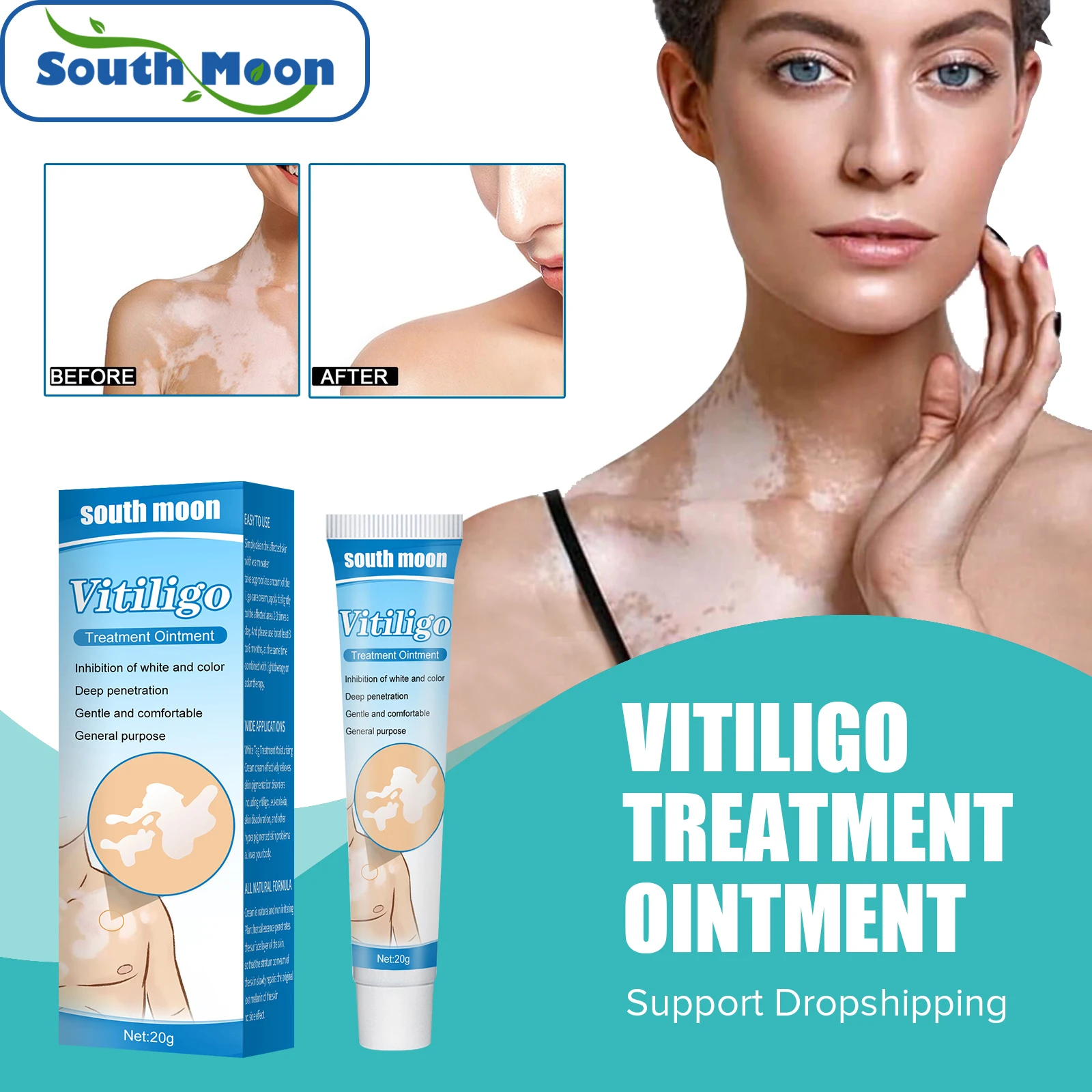 South Moon Vitiligo Treatment Ointment Antibacterial Remove White Spot