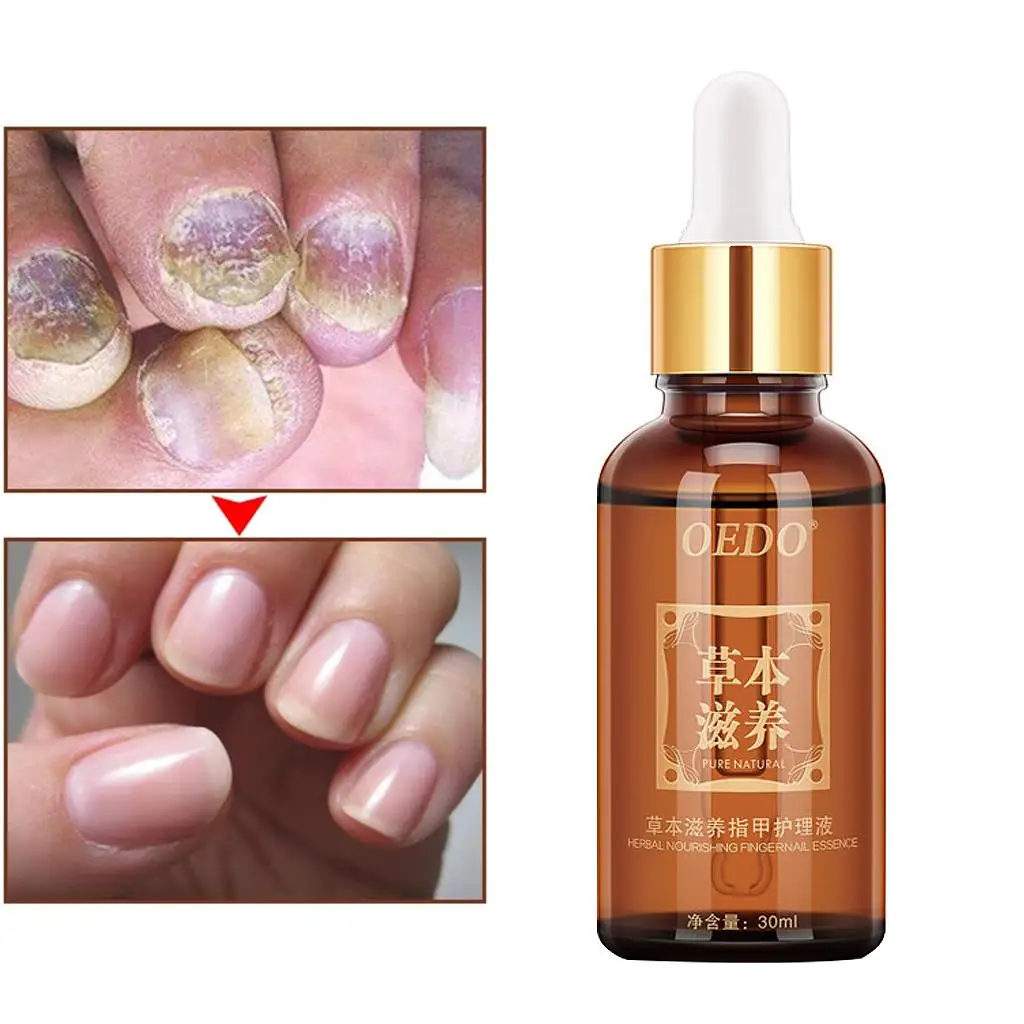 30ml Natural Herbal Anti Fungal Nail Treatment Essential Oil Liquid