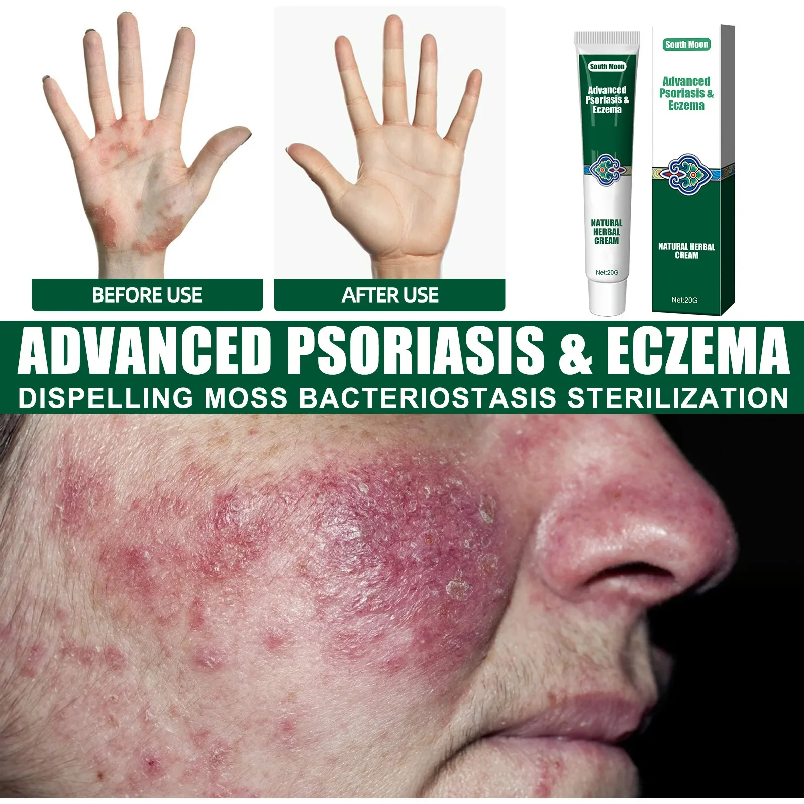 South Moon Psoriasis Ointment Eczema Herbal Cream Treatment Urticaria Desquamation Antibacterial Anti-Itching Health Skin Care