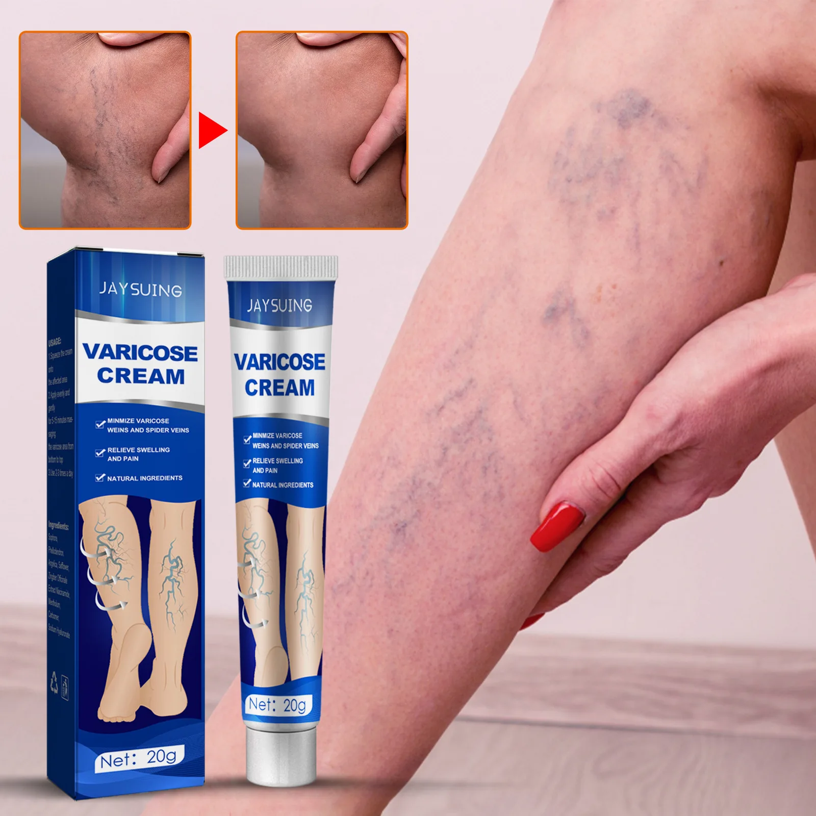 

Effective Treatment Varicose Veins Cream Spider Legs Vasculitis Pain Relief Ointment For Varicose Veins Feet Care Cream 20g