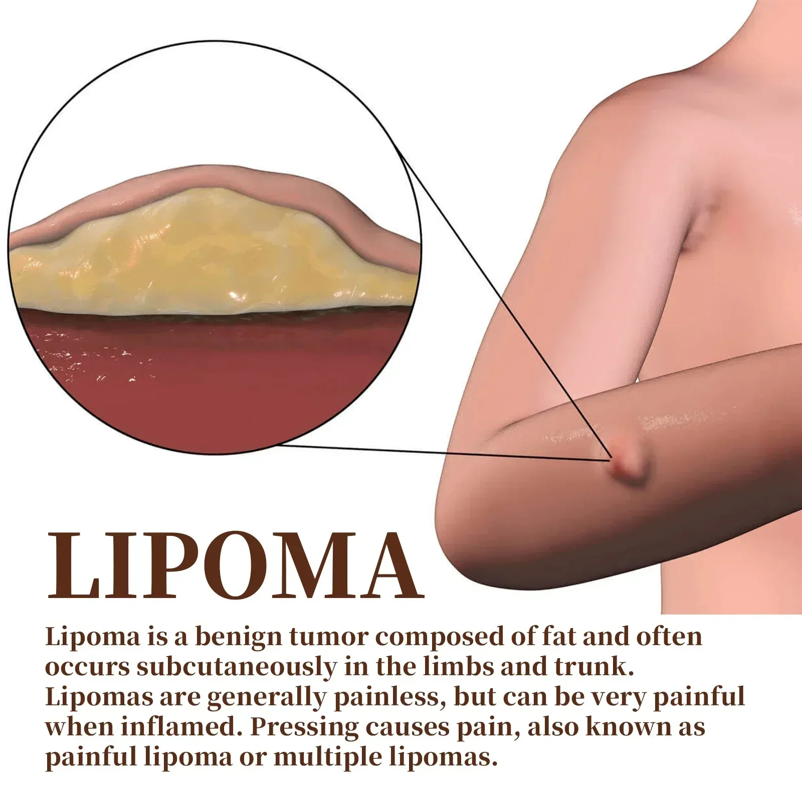 Description Picture 5 of itemLipoma Removal Cream Relief Swelling Fat Elimination Cream Remove Subcutaneous Lump Extract Care Fat Bulges Lump