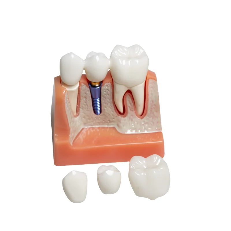 치과 모형, 레진 9.5x6.5x5cm, 치아 교육용, 학습용 치아, PVC 치과 교육 도구, 해부학 시연용