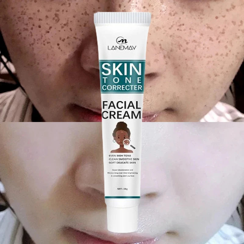 Permant Freckle Removal Cream Face Dark Blemish Melasma Remover Lightening Melanin Moisturize Brighten Whitening Skin Care