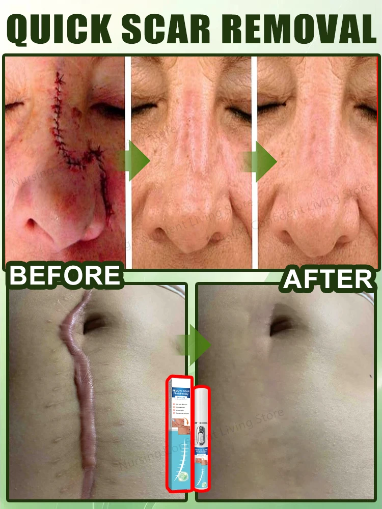 Laser scar repair 4