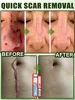 Laser scar repair 4