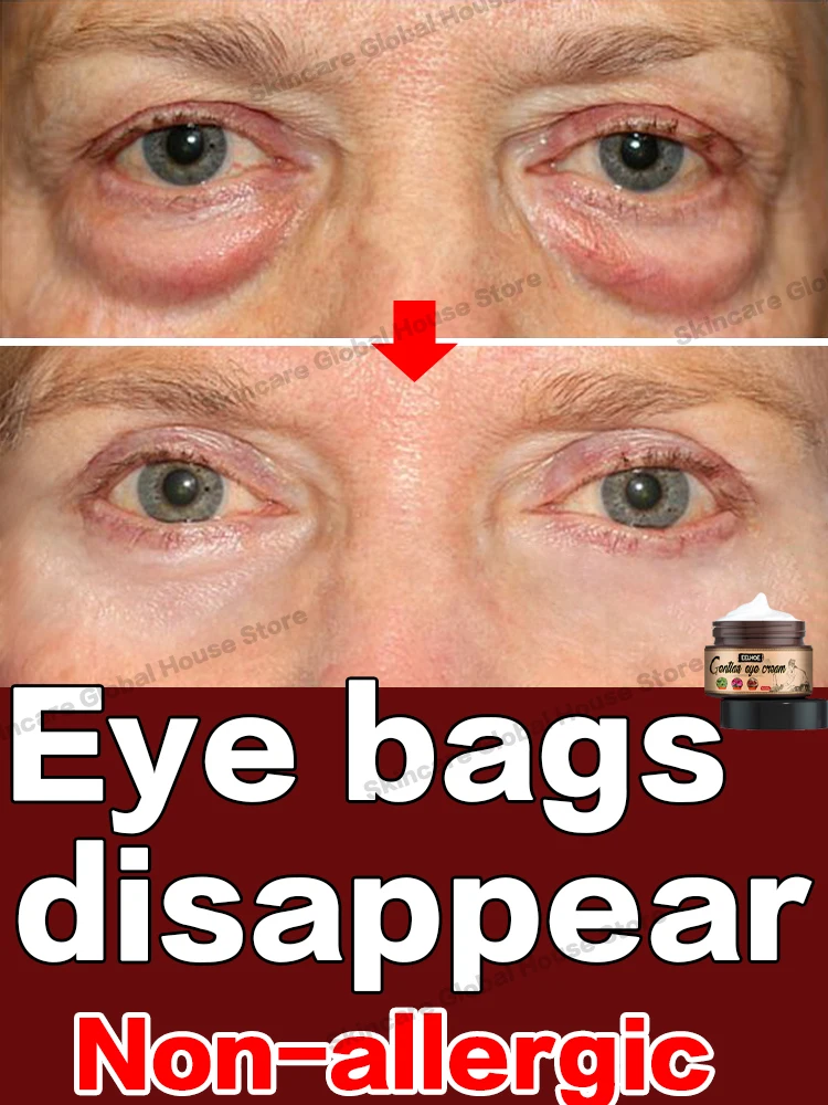 Details 150+ photos of bags under eyes 3tdesign.edu.vn