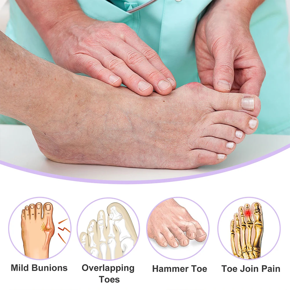 4PCS Silicone Thumb Corrector Bunion Toe Spreader Separator Hallux Valgus Protector Finger Straightener Adjuster Foot Care Tool