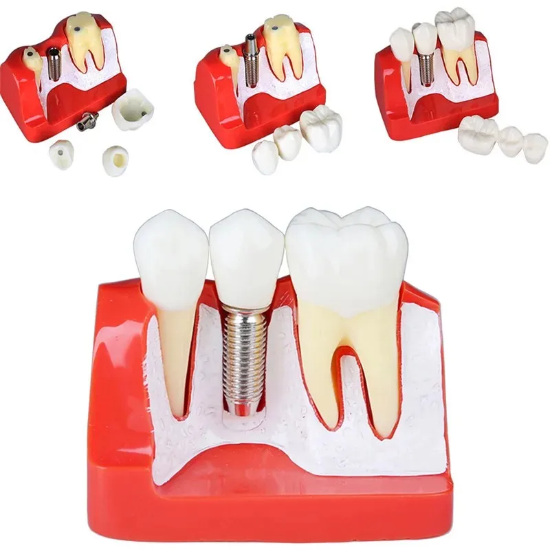1 pçs 4 vezes dentes modelo de implante dental dentes implante análise coroa ponte modelo removível dentista demonstração ensinar ferramentas