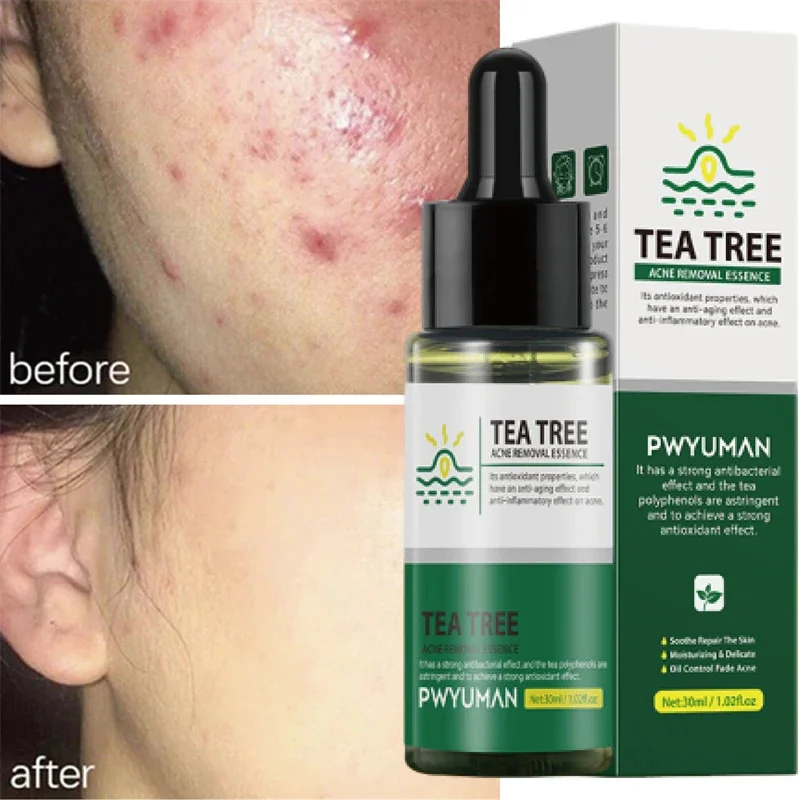 Tea Tree Acne Treatment Face Serum Anti Black Dots Removal Acne Marks Pimples Whitening Moisturizing Skin Care Korean Cosmetic vitamin c serum for face whitening dark spot remover hyaluronic acid black dots removal facial moisturizing skin care