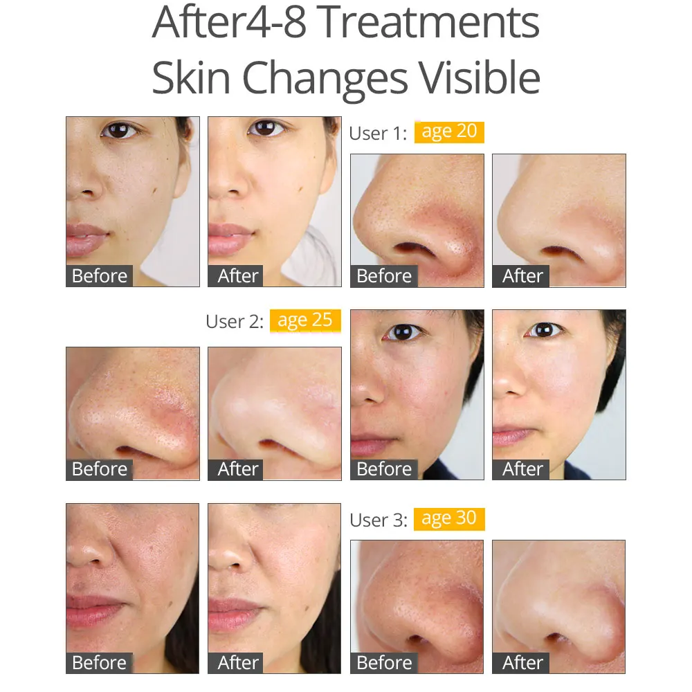 Professional Diamond Microdermabrasion Machine For Facial Peeling Skin Care Blackhead Removel Water Spray Exfoliation Machine 07 6