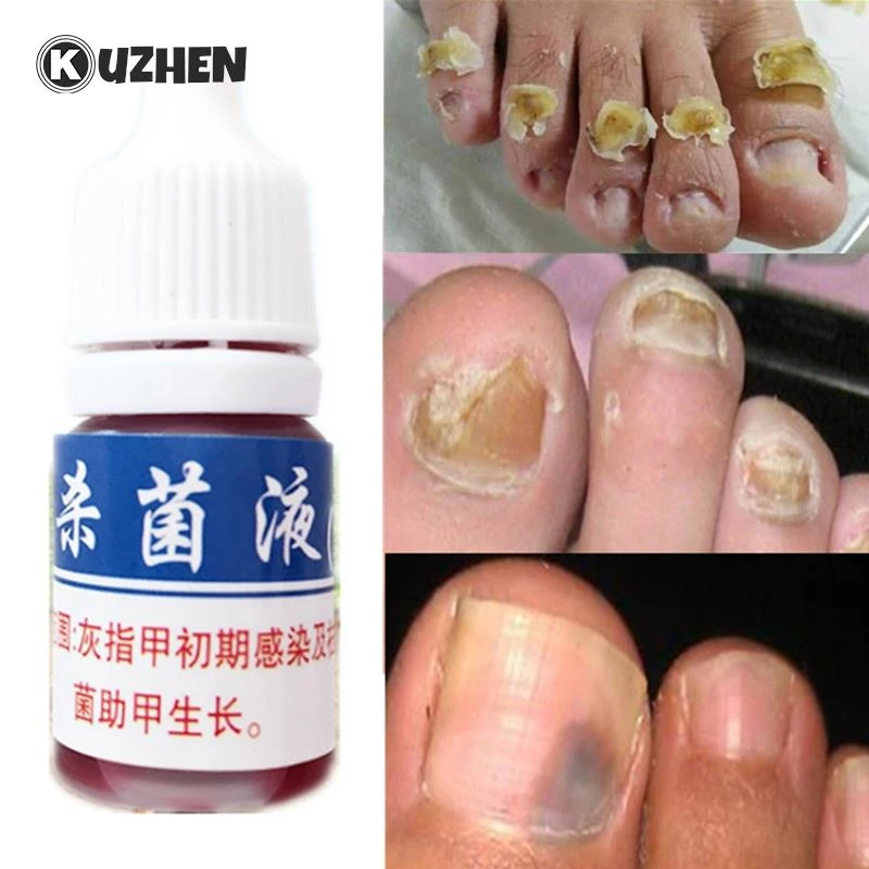 爪水虫と爪床水虫について 爪甲真菌炎液体手と足の爪甲真菌症のケアと修復 Studio Ellis Be