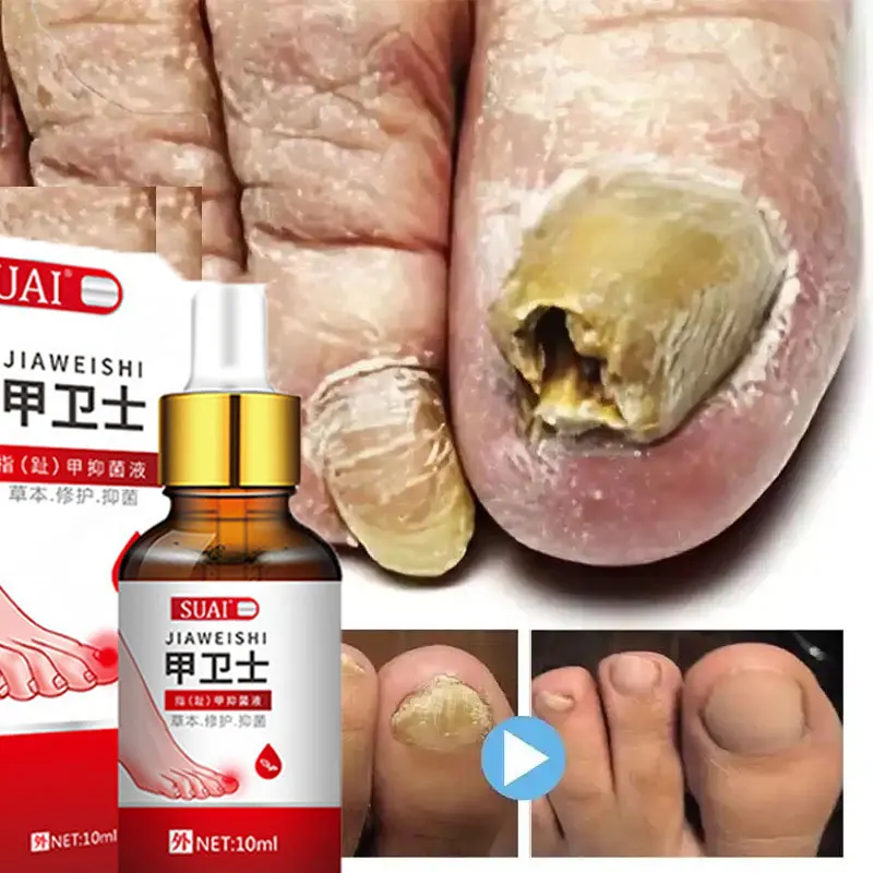 10ML Nail Fungal Treatment Serum Repair Gel Care Beauty Health