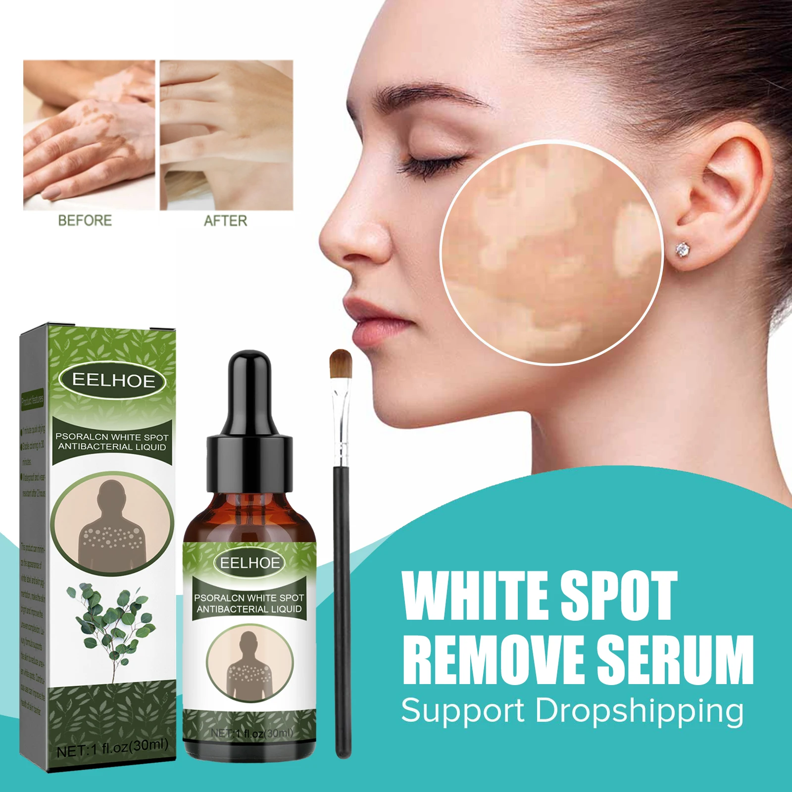 

Витилиго Treament эссенция антибактериальное удаление псориаза микоз лейкоплакия режущий червь неровный тон кожи сыворотка белого пятна