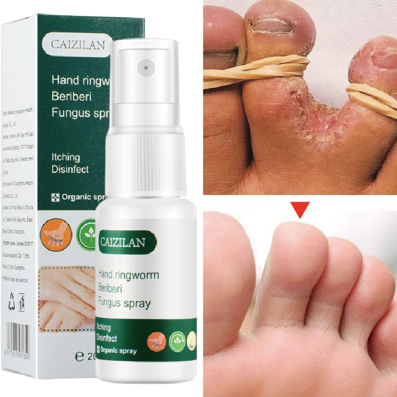 

Anti Fungal Spray Foot Fungal Cream Relieve Beriberi Toe Treatment Gel for Cracked Heel Peeling Blister Repairing Feet Ointment