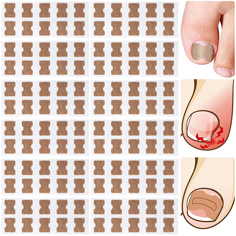 50pcs Nail Correction Stickers Ingrown Toenail Corrector Patches Waterproof Paronychia Treatment Recover Corrector Pedicure Tool