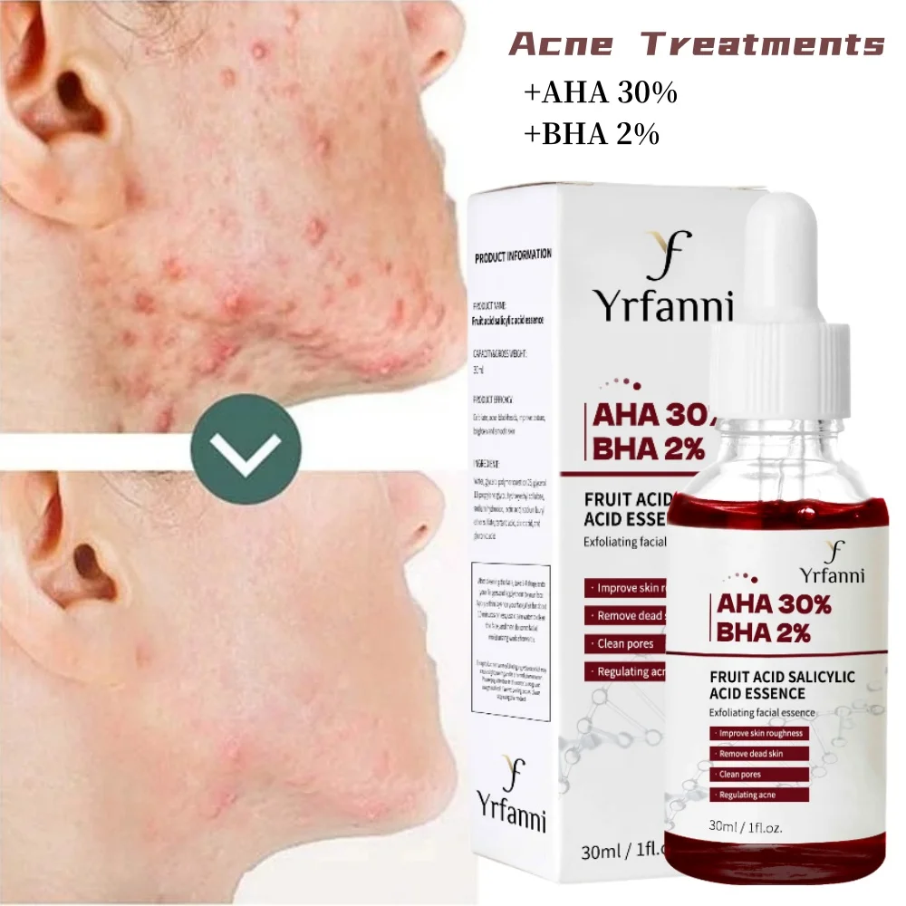 

Fruit Acid Acne Treatments Face Serum Fade Acne Marks Pores Shrinking Blackheads Removal Whitening Smooth Moisturizing Skin Care